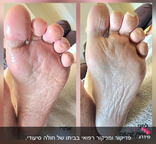 תמונת לפני ואחרי של טיפול בכף רגל